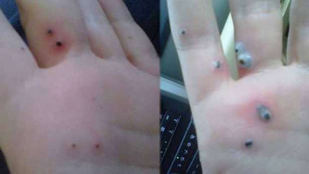 Adolescente sufre de esta enfermedad en las manos 