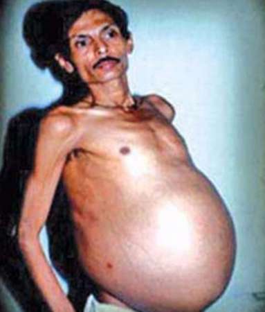 Hombre con estómago  gigante se somete a cirugía pero encuentran algo sorprendente  - Foto 0 