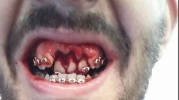 Le destrozan los dientes a jugador de fútbol 