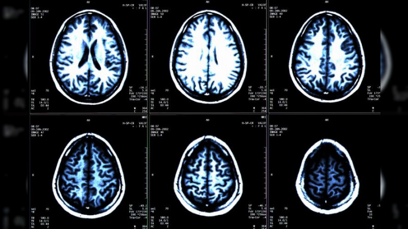 Induce diabetes envejecimiento cerebral acelerado: UNAM 