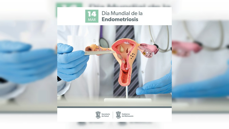 La endometriosis puede presentar síntomas como menstruación dolorosa o infertilidad: SSM 
