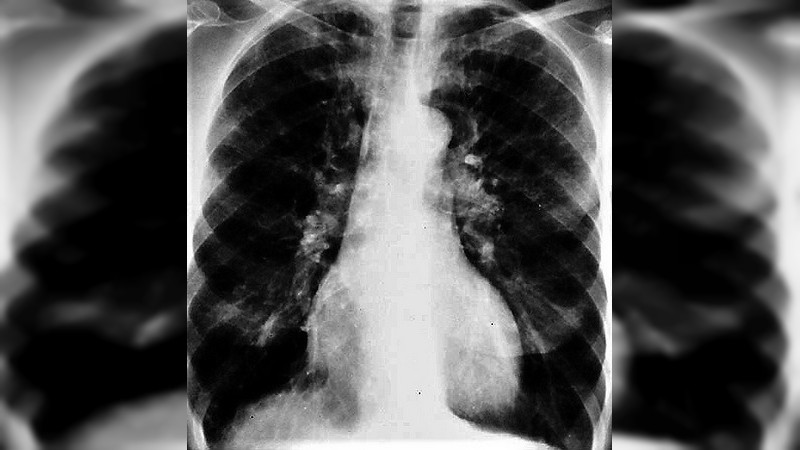 Secretaria de Salud  de Michoacán llama a la población que consume tabaco a realizarse un diagnóstico de cáncer pulmonar 