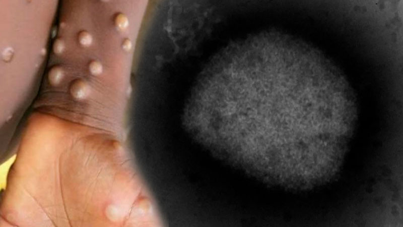 Obtienen en España secuencia completa del virus causante de viruela del mono 