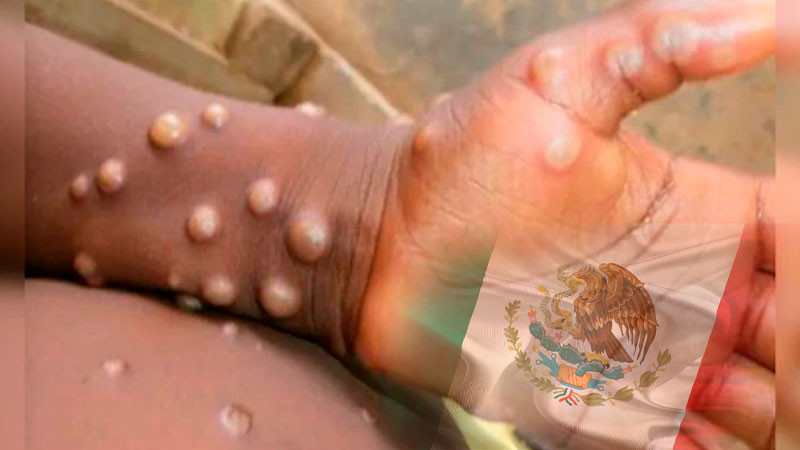 Primer caso de viruela del mono en México se encuentra en CDMX, confirma López-Gatell 
