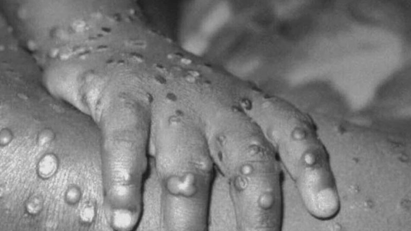 Analizan en Baja California un caso sospechoso de viruela del mono 