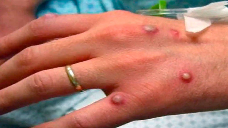 OMS alerta: casos de viruela del mono en Europa se triplicaron en las últimas 2 semanas 