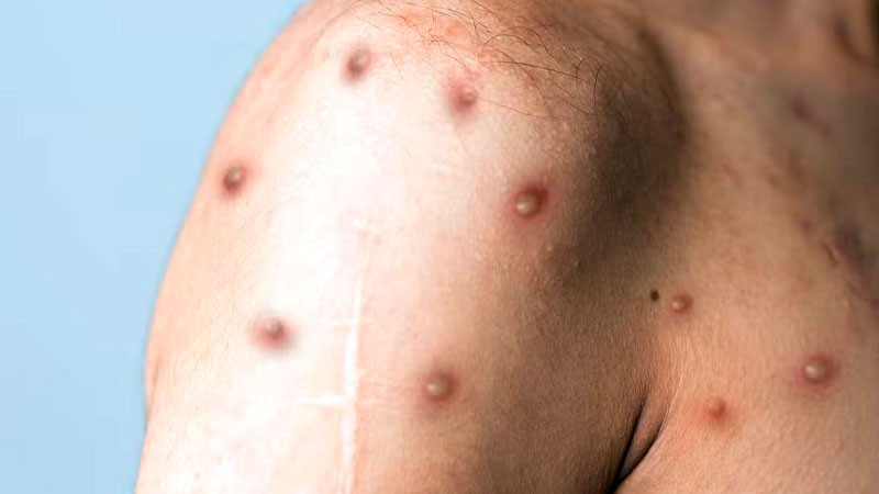 Casos de viruela del mono aumentan 77 porciento en el mundo en una semana, informa la OMS 