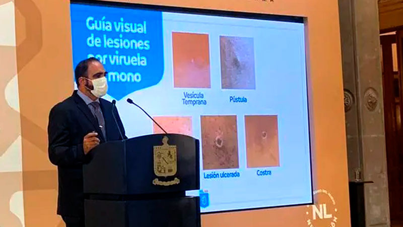 Confirman primer caso de Viruela del Mono en Nuevo León, es un paciente con VIH 