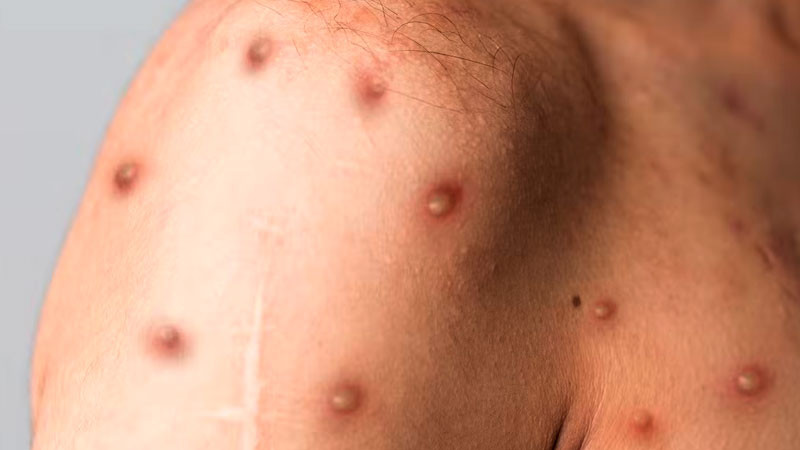 Experto de la OMS advierte que viruela del mono se declarará pandemia 