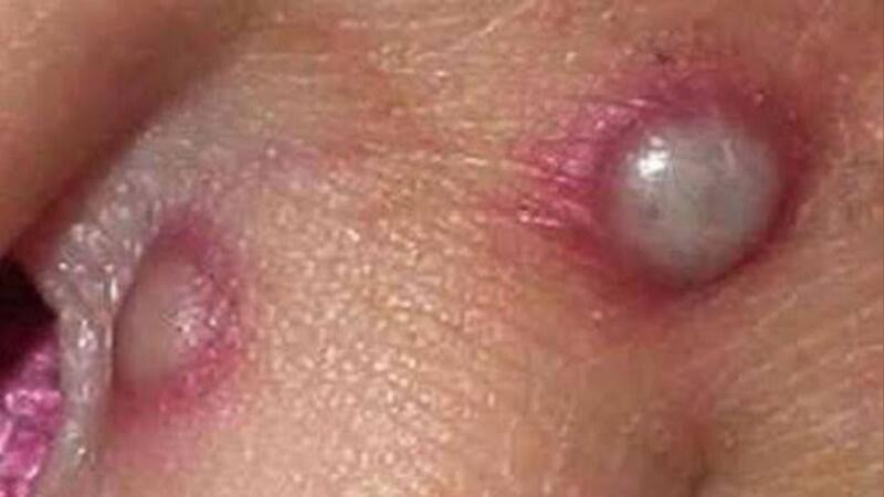 OMS registra más de 26 mil casos de viruela del mono en el mundo y 9 muertes 
