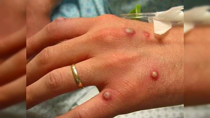 En Jalisco 6 nuevos casos de Viruela del Mono, confirma Secretaría de Salud 
