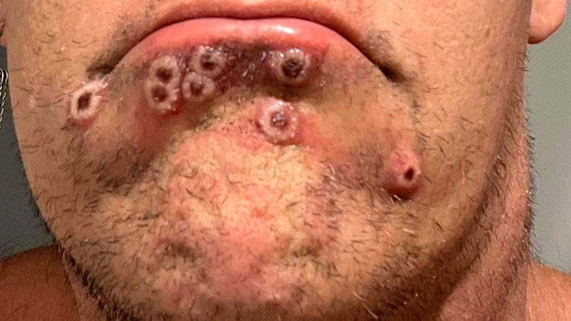 Aumentan a 386 los casos de viruela del mono en México 