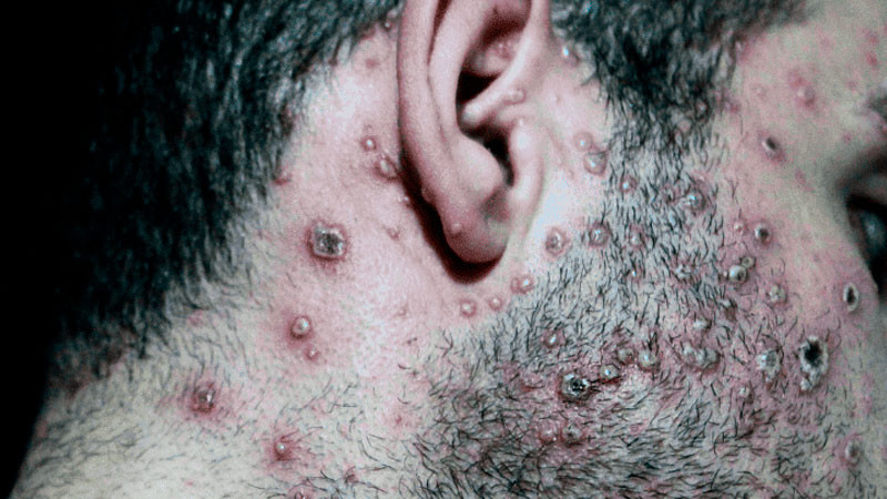 México contabiliza 504 casos de viruela símica 