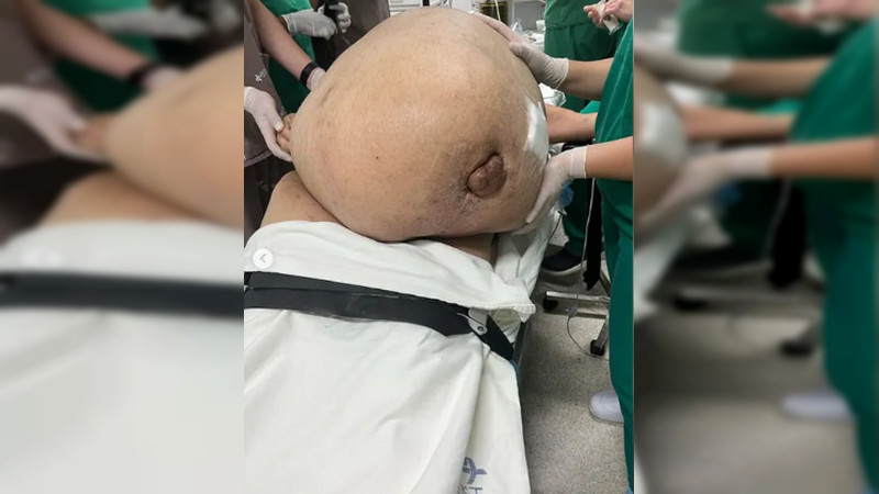 Extirpan tumor de 46 kilos en Brasil; analizan si es maligno