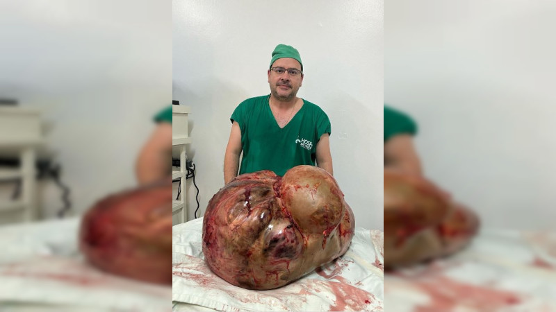 Extirpan tumor de 46 kilos en Brasil; analizan si es maligno