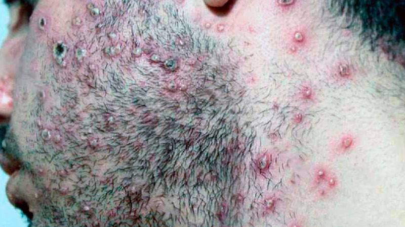Van mil 367 contagios confirmados de viruela del simio, en 30 estados de México 
