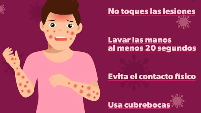 Llama Secretaría de Salud de Michoacán a mantener prevención de contagios de viruela símica  