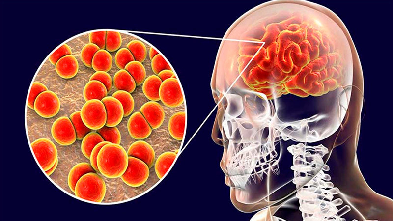Mueren dos por Meningitis en Durango 