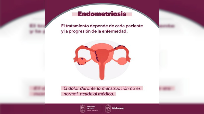 Hospital de la Mujer, único centro público que atiende la endometriosis