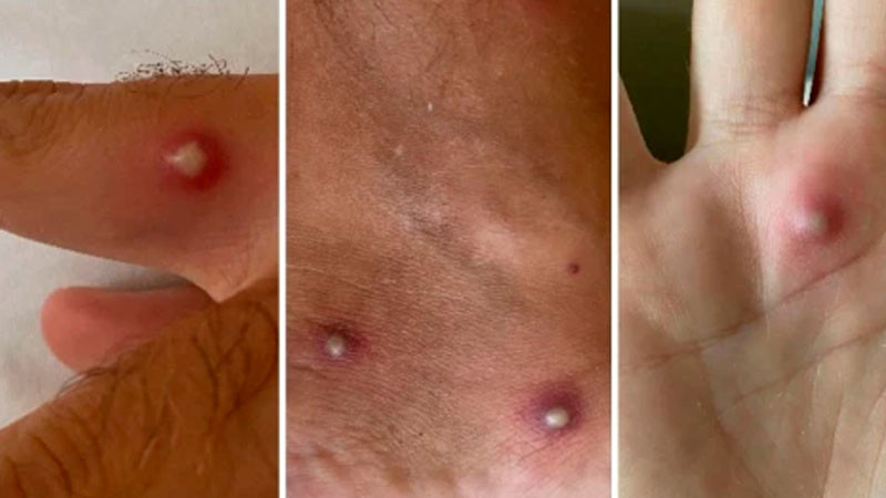 En últimos 14 días, Secretaría de Salud confirma nueve casos de mpox 