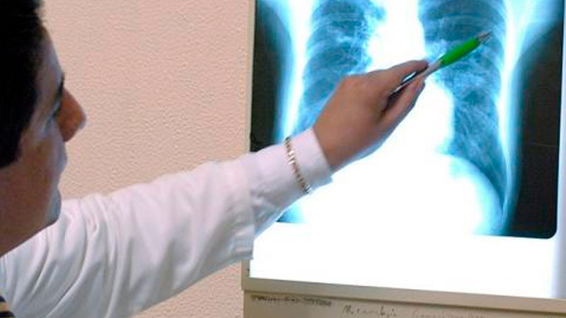 En México, 40% de las personas con tuberculosis resistente a fármacos padece también diabetes 