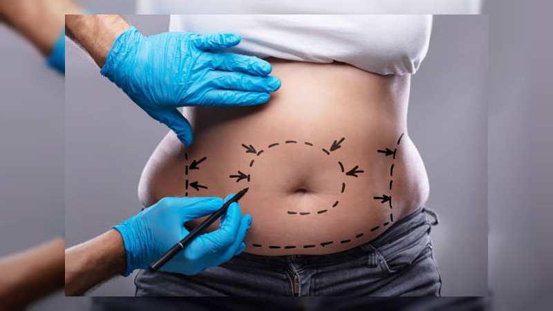 Enfermera se realiza “auto liposucción” y pierde la vida en Cuernavaca, Morelos  