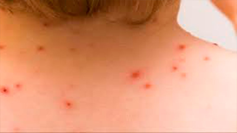 México acumula 3 mil 956 casos confirmados de Mpox 