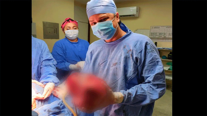 Médicos del IMSS de Veracruz extirpan un tumor maligno de 13 kilogramos 