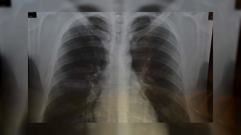 INCan cuenta con primer programa gratuito en México para detección de cáncer de pulmón 