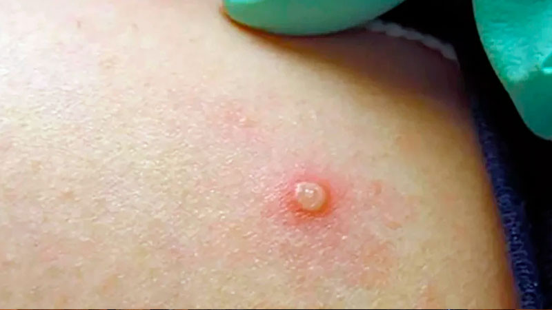 Bajan contagios de mpox en México; en últimos 14 días Secretaría de Salud confirma 4 