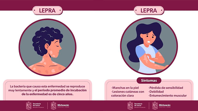 Michoacán garantiza la atención gratuita a pacientes con lepra