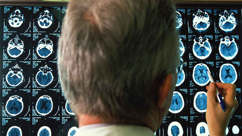 Científicos del Reino Unido y Bélgica desentrañan misterio en el Alzheimer 
