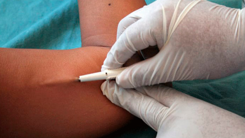 Aplica Salud Michoacán implantes subdérmicos gratuitos para para prevenir embarazos 