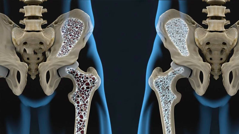 Osteoporosis afecta una de cada tres mujeres y uno de cada cinco hombres mayores de 50 años: INR 