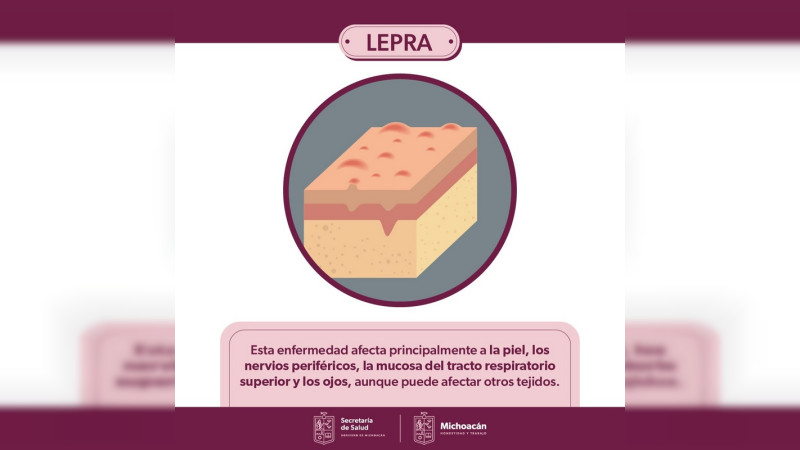 Sector Salud brinda detección oportuna y tratamiento gratuito contra la lepra en Michoacán 