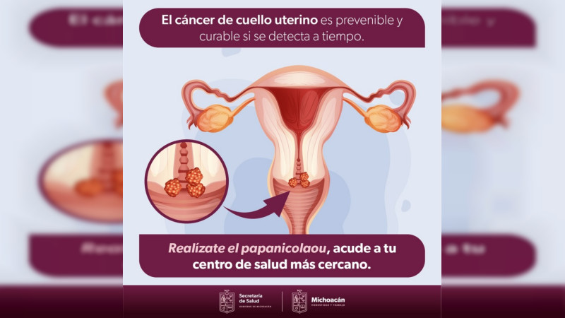 Invita sector salud de Michoacán a realizar prueba gratuita de Papanicolaou 