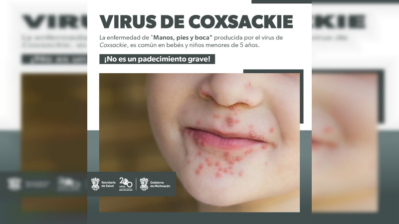 Conoce cómo prevenir el virus coxsackie que afecta a menores de 5 años