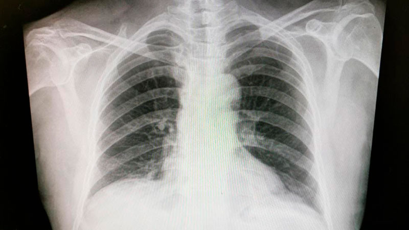 Impulsa Issste diagnóstico oportuno y tratamientos eficaces para cáncer de pulmón  