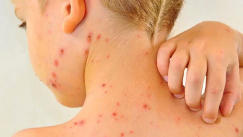 Emiten alerta epidemiológica casos importados de sarampión en México