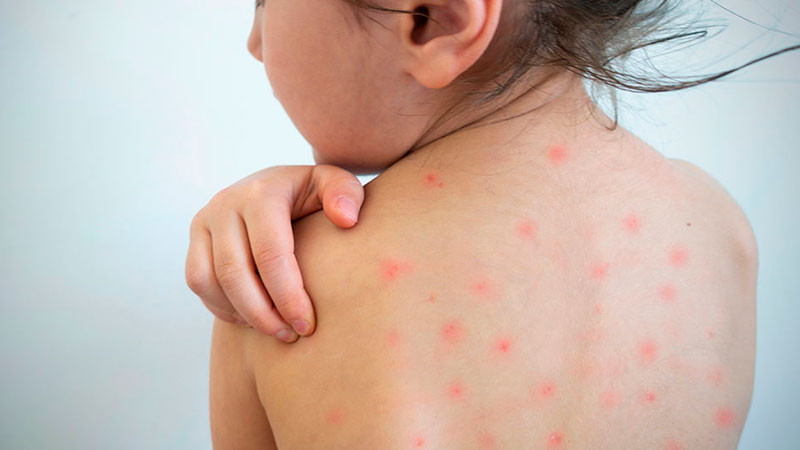 UNAM alerta por aumento de casos de sarampión en la CDMX