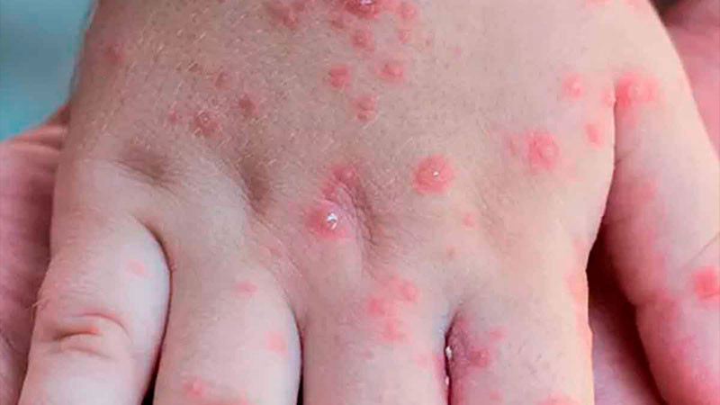 Reportan alerta sanitaria por brotes de virus coxsackie en Hidalgo 