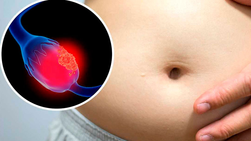 Conoce cuáles son los síntomas del cáncer de ovario; podrías salvar tu vida