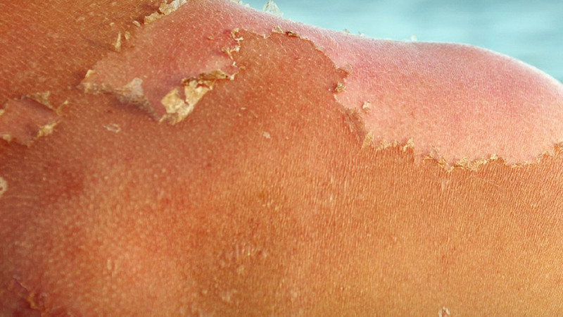 Exponerte al sol sin protección podría causarte estos daños, alerta sector salud 