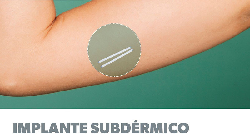 Cuenta sector salud con implantes subdérmicos gratuitos para prevención de embarazos 