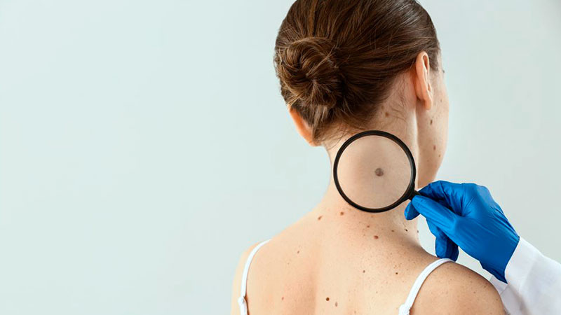 Campaña #BuscaElPunto suma nuevos tatuadores y aliados contra el cáncer de piel tipo melanoma  