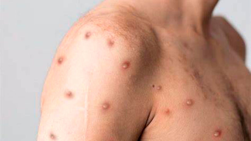 Salud reporta 49 casos de viruela de mono; emiten aviso epidemiológico  