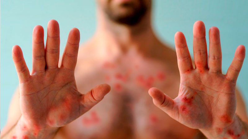 Confirma Suecia primer caso de mpox fuera de África 