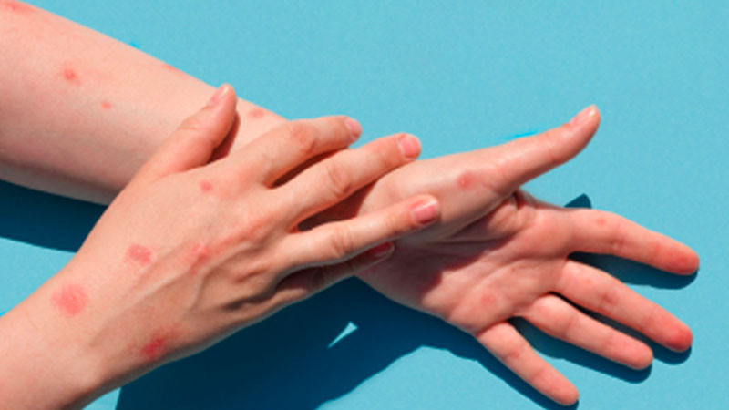 Salud confirma tres casos positivos de mpox; uno en Veracruz y dos en Cdmx 