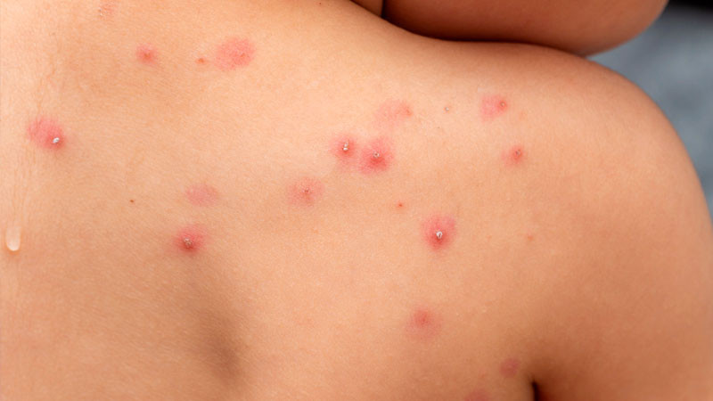 Reportan dos nuevos casos de Mpox en Ciudad de México y Estado de México 