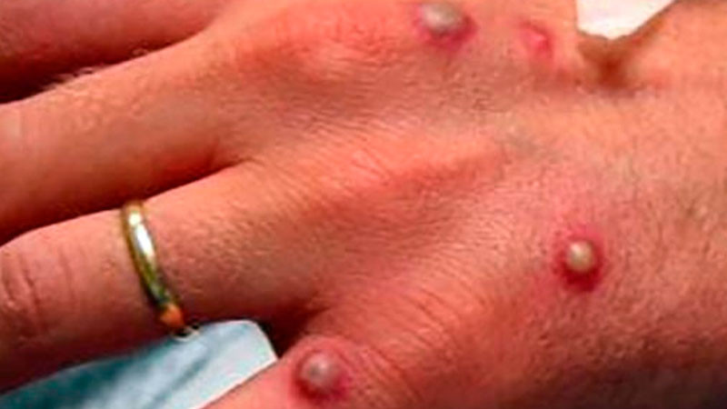 Confirman primer caso de Mpox en Baja California Sur 